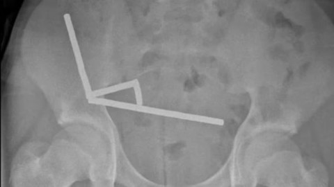 Novi Zeland: Dječak progutao 100 snažnih magneta, formirali četiri lanca u crijevima thumb2.jpg