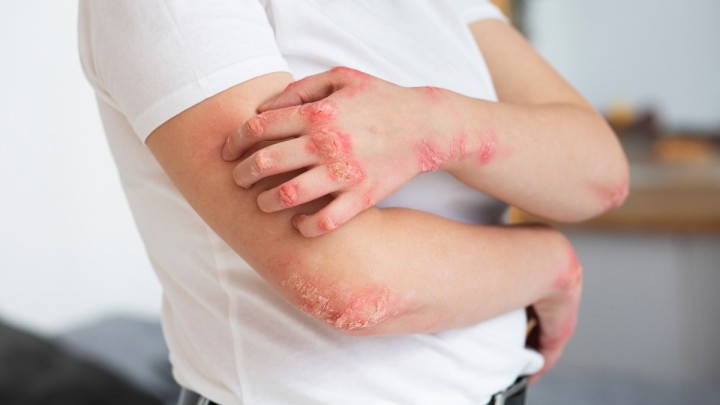 Međunarodni dan: Psorijaza pogađa i cijele porodice thumb3.jpg