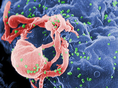 HIV otkriven prije 30 godina HIV otkriven prije 30 godina