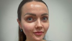 Zaboravite filere, u trendu su injekcije riblje sperme