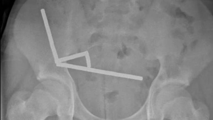 Novi Zeland: Dječak progutao 100 snažnih magneta, formirali četiri lanca u crijevima thumb3.jpg
