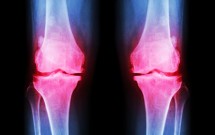 Osteoartritis: Optimistične prognoze za nove tretmane lečenja