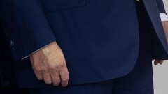 Tramp ima probleme sa venama, saopštila Bela kuća