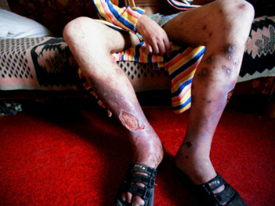 Droga ''krokodil'' stigla u Hrvatsku legs.jpg