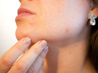 998034_acne-1606765960720jpg